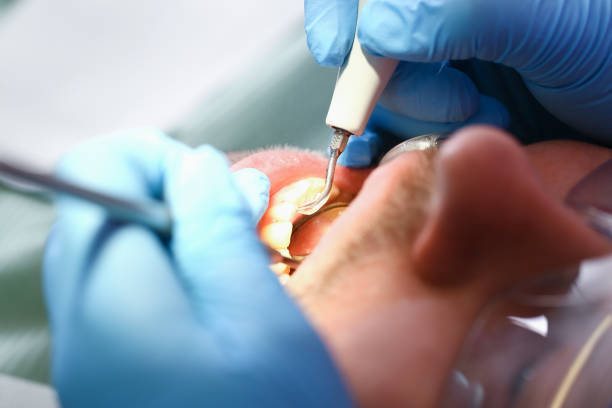 Best Emergency Dentist for Knocked-Out Tooth in Culver City, CA